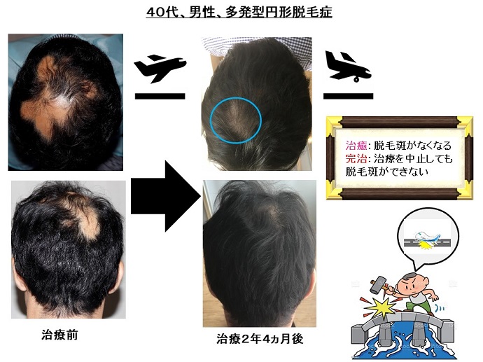 円形脱毛症　病院
